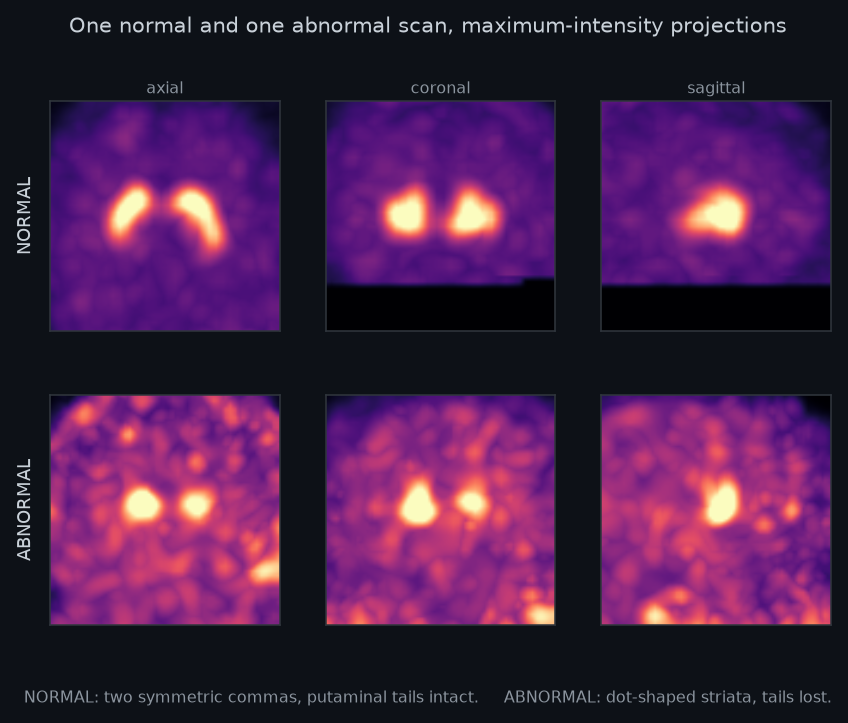 Normal and abnormal DaT SPECT brain scans shown in axial, coronal, and sagittal views